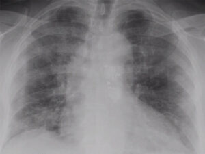 BTK inhibitors improve COVID-19 outcomes by targeting upstream switch for inflammation, early data suggest