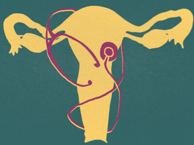 The 50-year history of abortion and oncology in The Cancer Letter archives