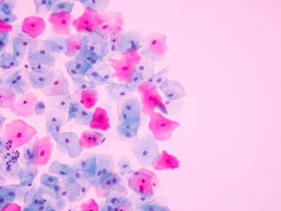 Self-collection kits for HPV are among innovations adding momentum to eradication of cervical cancer A kit for at-home unsupervised self-collection clears FDA finish line