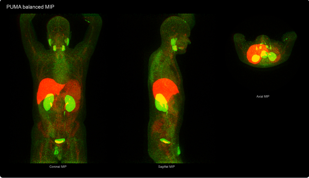 Three Maximum Intensity Projection (MIP) images (3D computer visualizations) of Sijbrandij's body from the coronal, sagittal, and axial perspectives using his February PET scans. Large sections of his body&mdash;his kidneys and bladder, as well as other organs&mdash;are lit up red and green depending on the target tracer. 