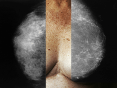 Two years after FDA’s breast density notification rule, there is still no standard for follow-up So far, 38 million patients have received a dense breast notification. Now what?
